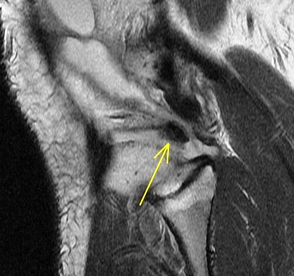 Figure 2 for case Unstable lateral meniscus flap tear